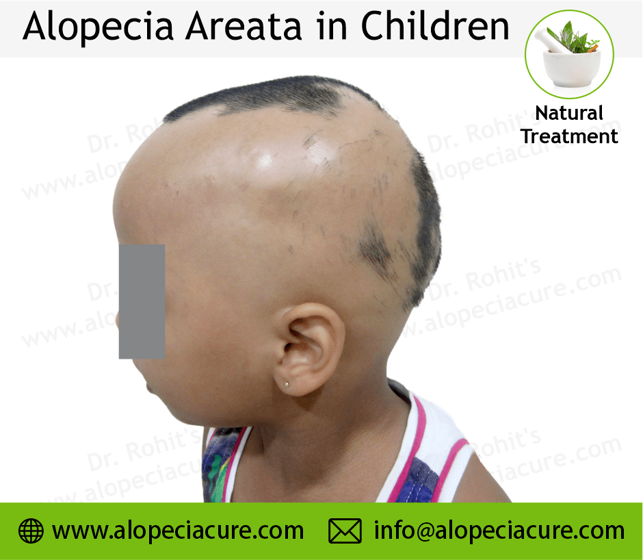 Children Alopecia Treatment Case 08
