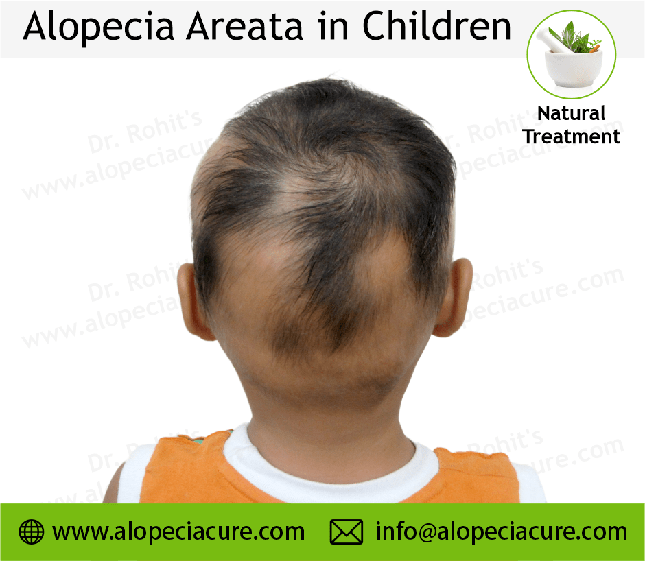 Children Alopecia Treatment Case 09