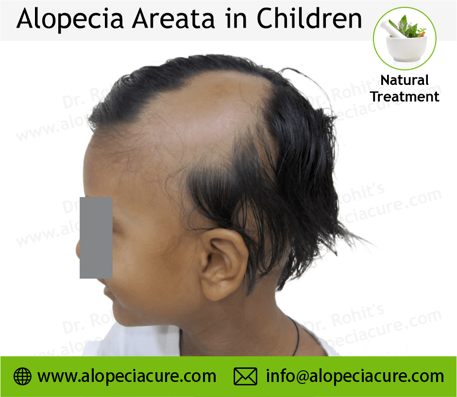 Children Alopecia Treatment Case 10