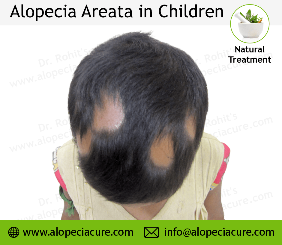 Children Alopecia Treatment Case 11
