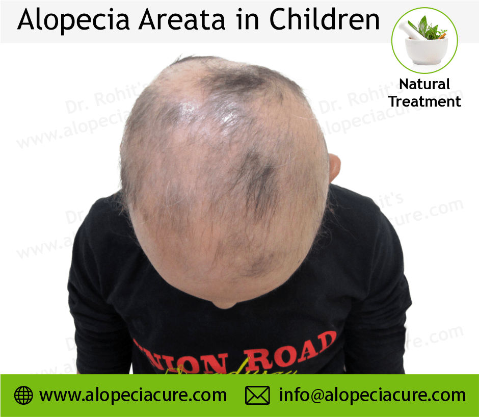 Children Alopecia Treatment Case 12