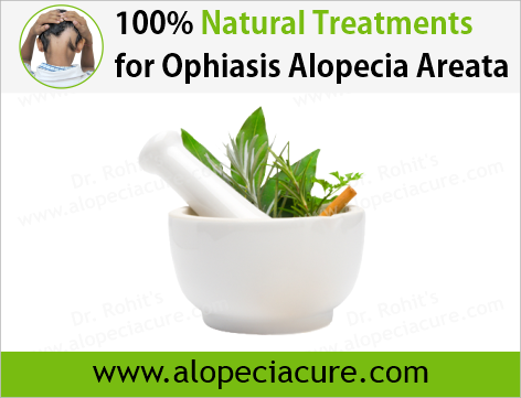 100% Natural Treatments for Ophiasis Alopecia Areata