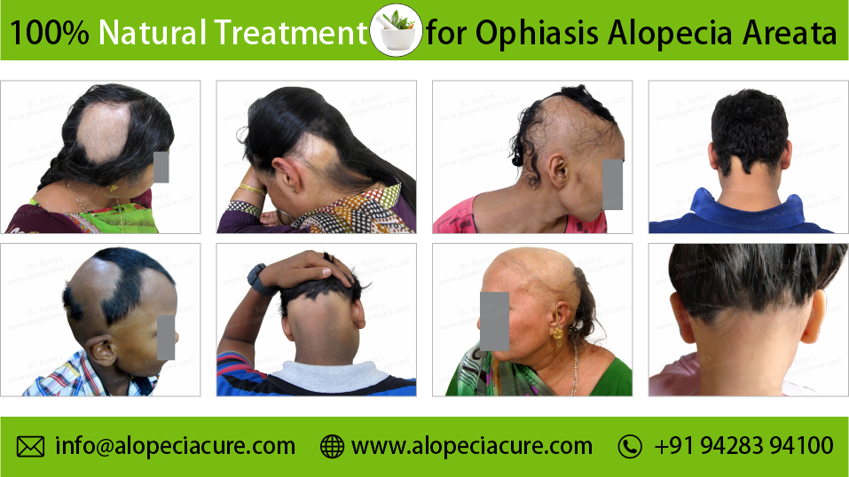 Patchy Alopecia Areata