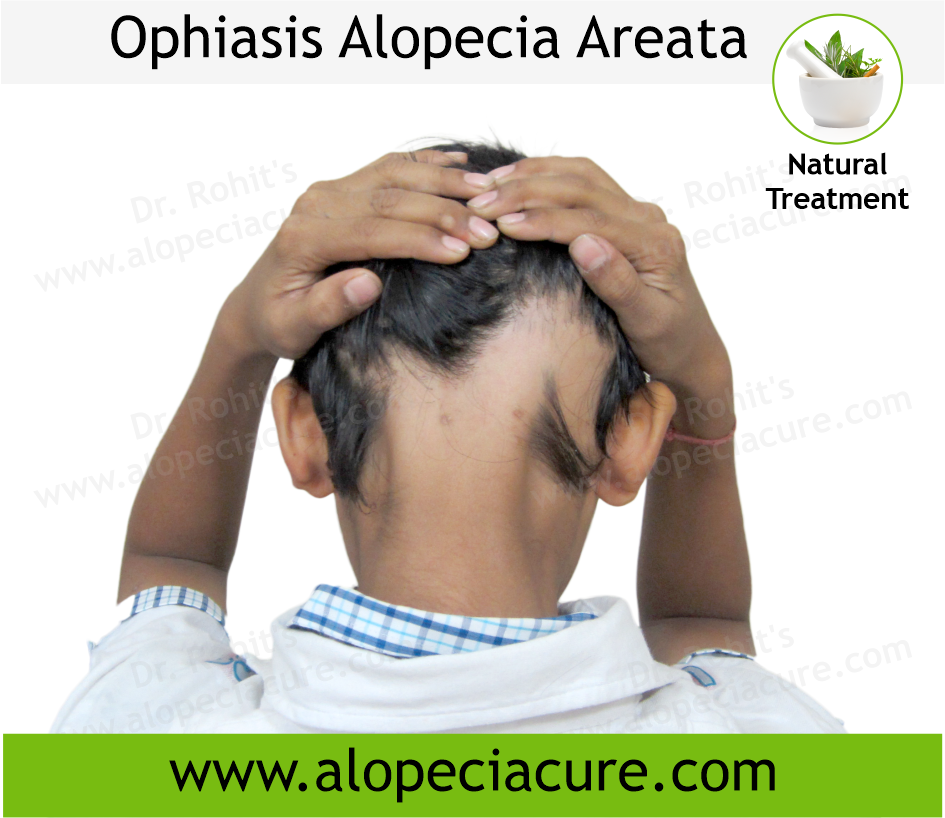 Alopecia Barbae Treatment Case 01