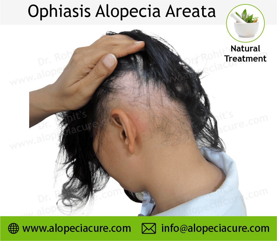 Alopecia Barbae Treatment Case 02