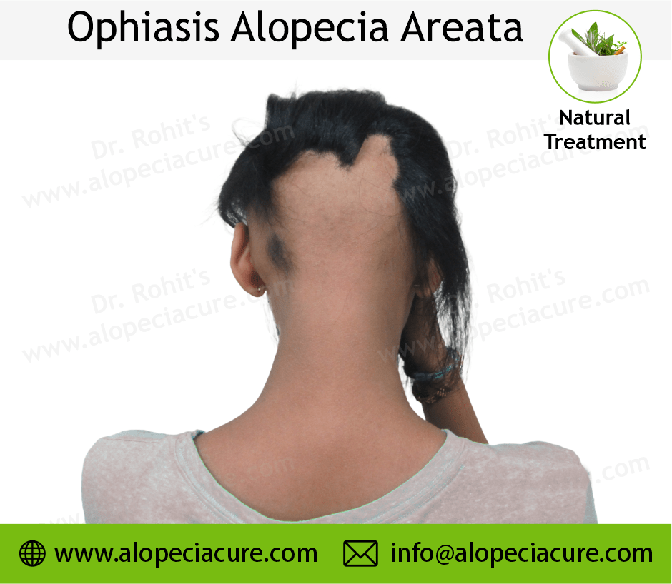Alopecia Barbae Treatment Case 03