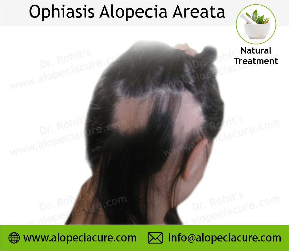 Alopecia Barbae Treatment Case 04