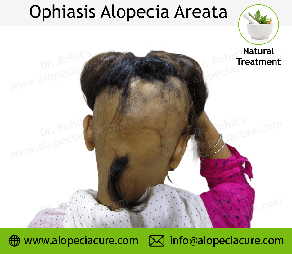 Alopecia Barbae Treatment Case 05