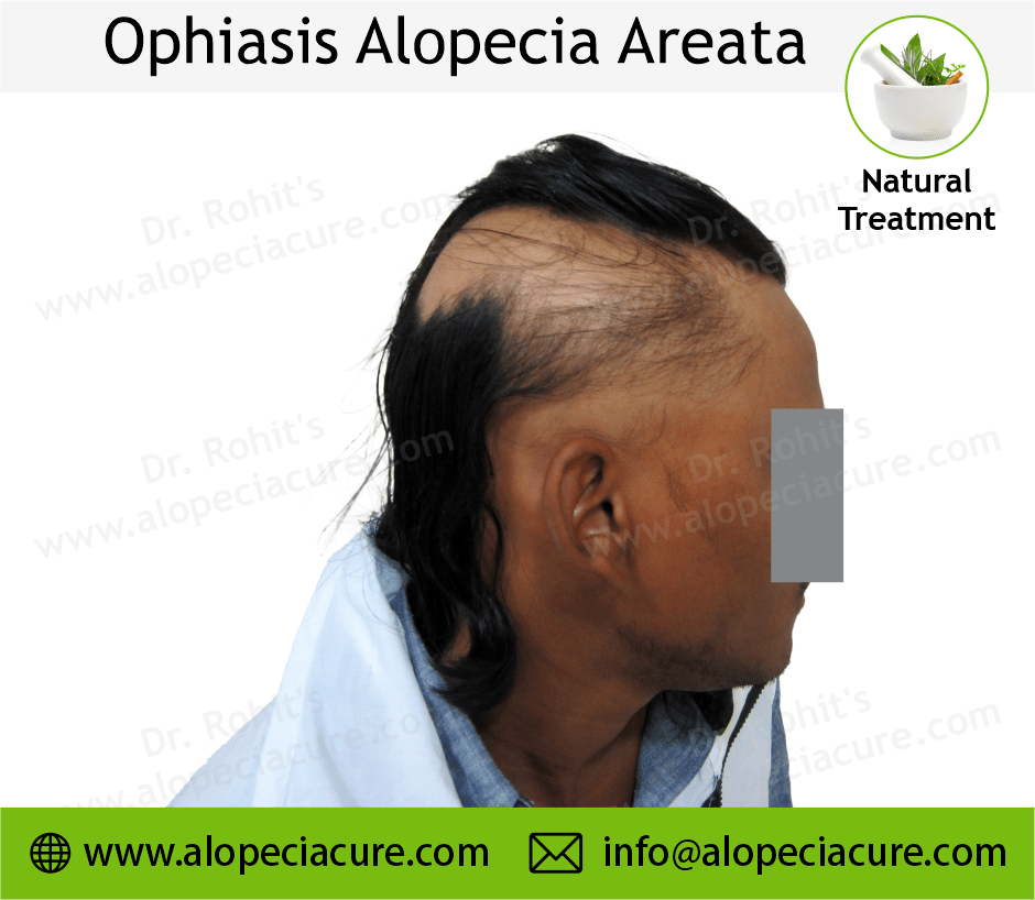 Alopecia Barbae Treatment Case 06