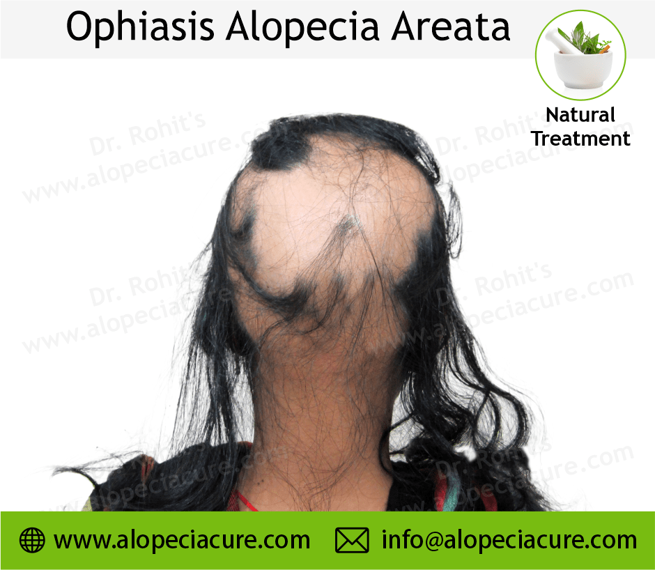 Alopecia Barbae Treatment Case 07