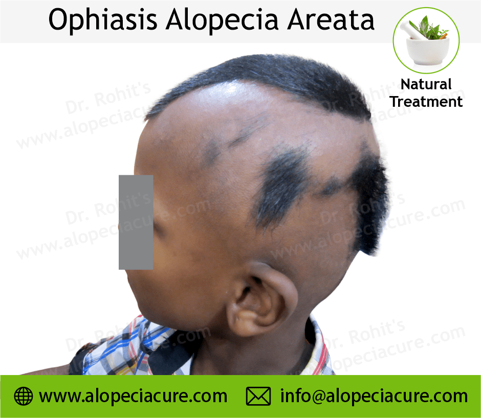 Alopecia Barbae Treatment Case 08