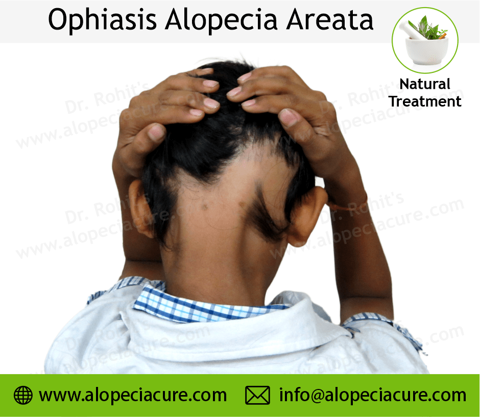 Alopecia Barbae Treatment Case 09