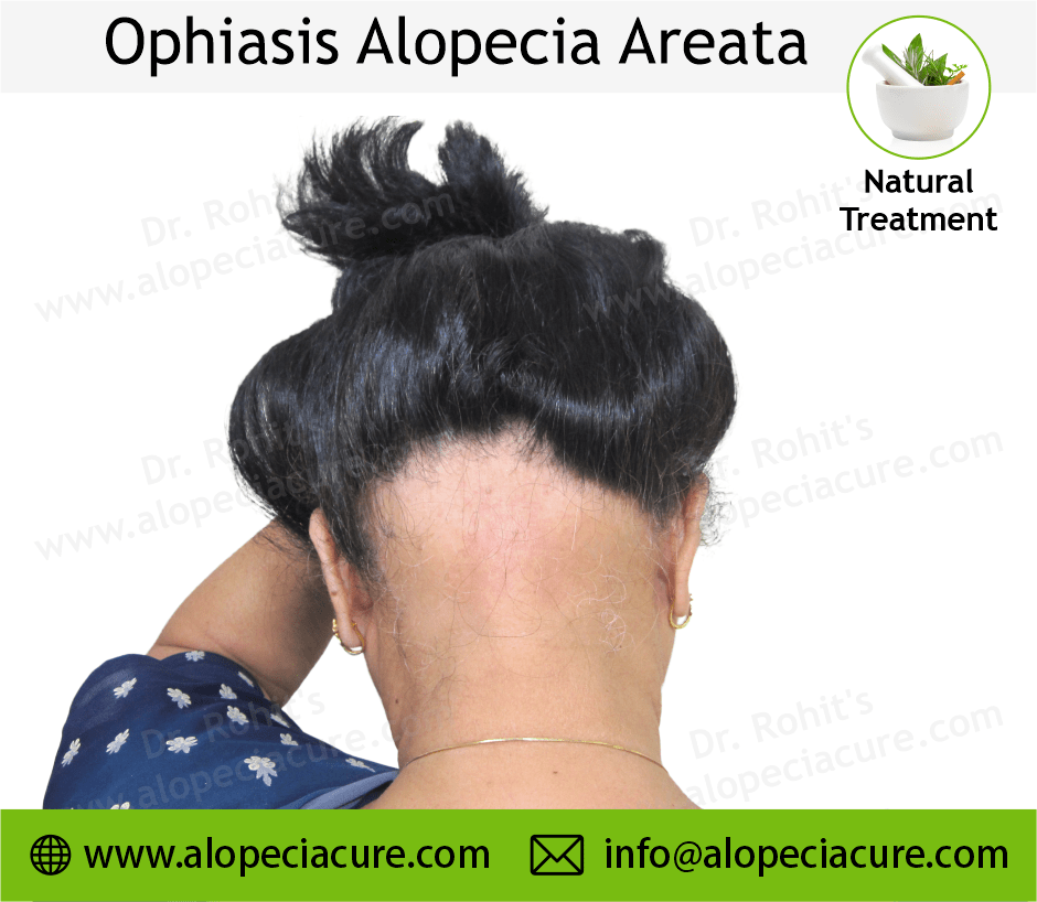 Alopecia Barbae Treatment Case 10