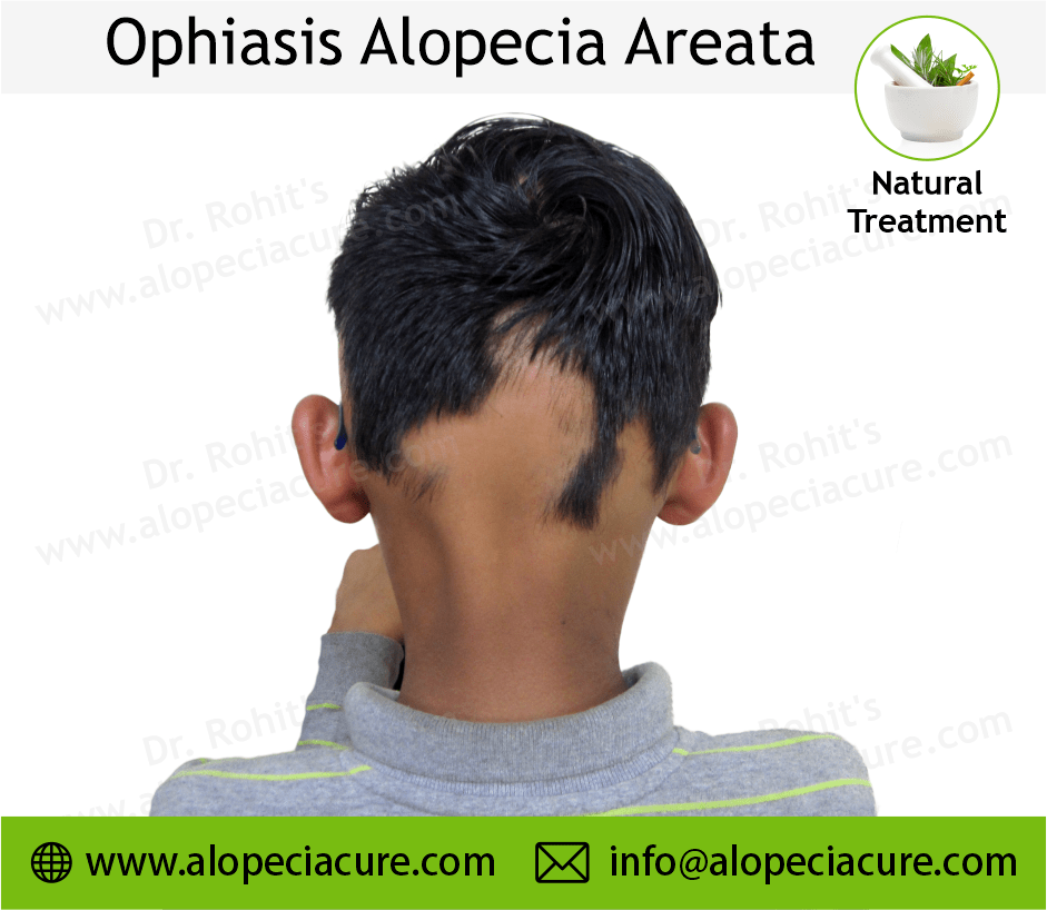 Alopecia Barbae Treatment Case 11