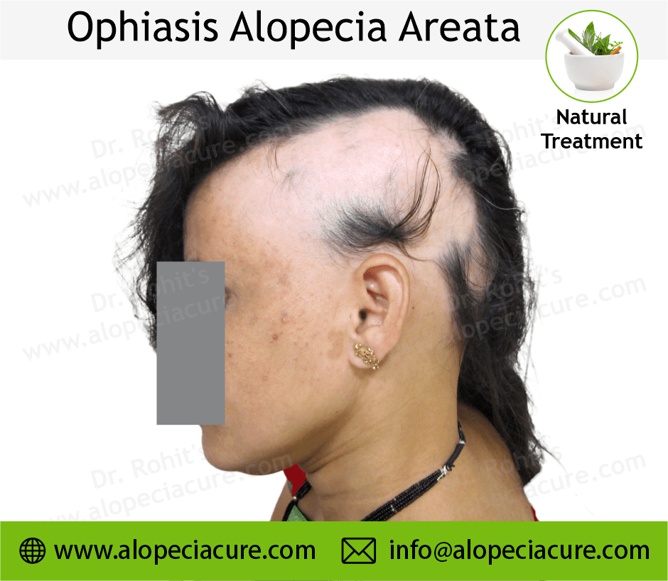 Alopecia Barbae Treatment Case 12