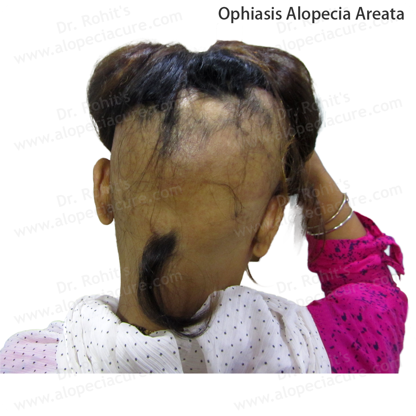 Ophiasis Alopecia Treatment 1