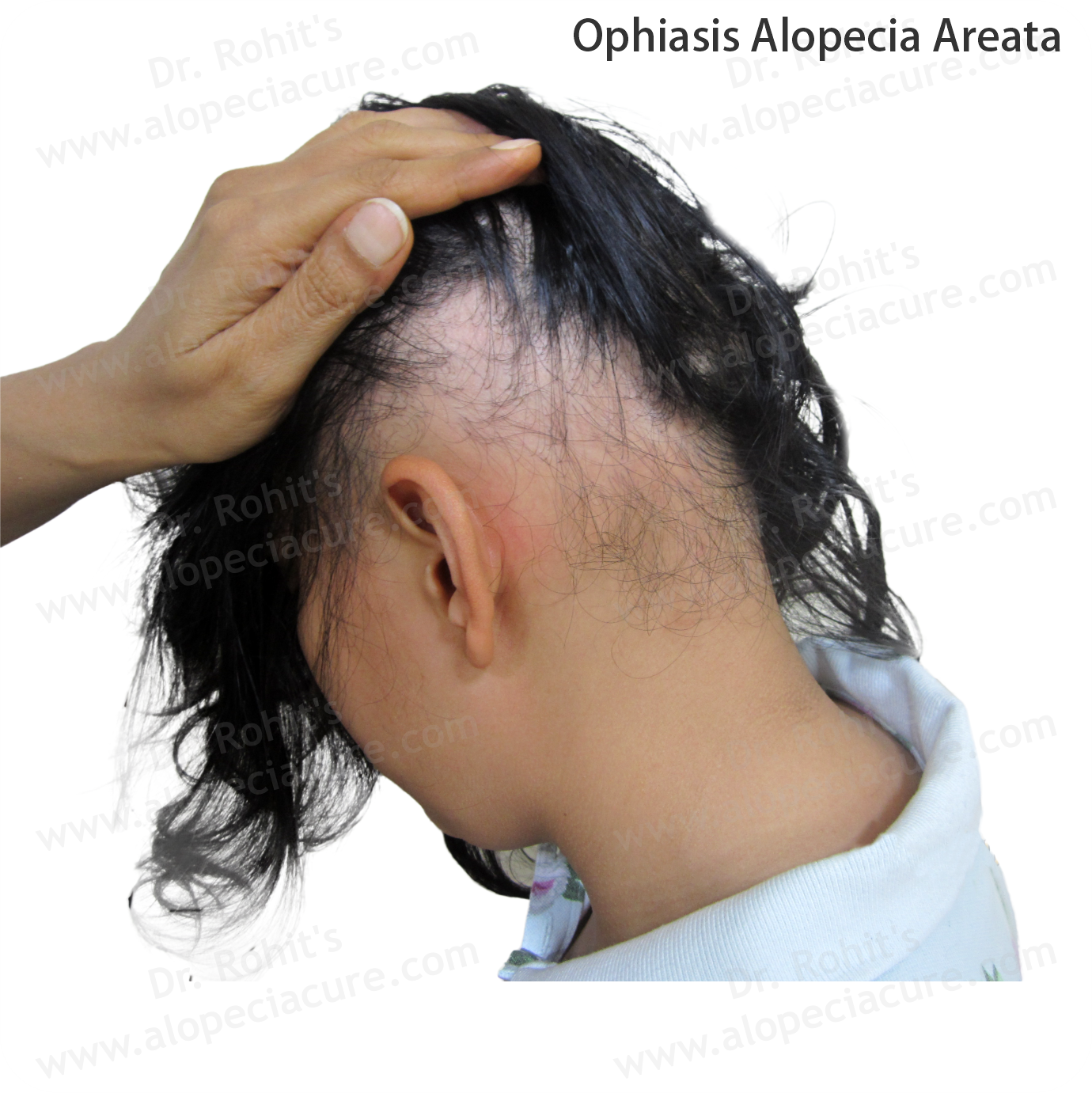 Ophiasis Alopecia Treatment 2