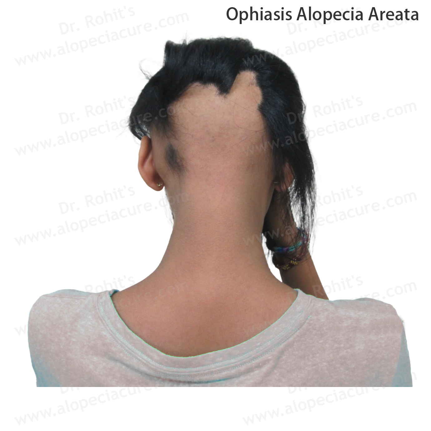 Ophiasis Alopecia Treatment 3