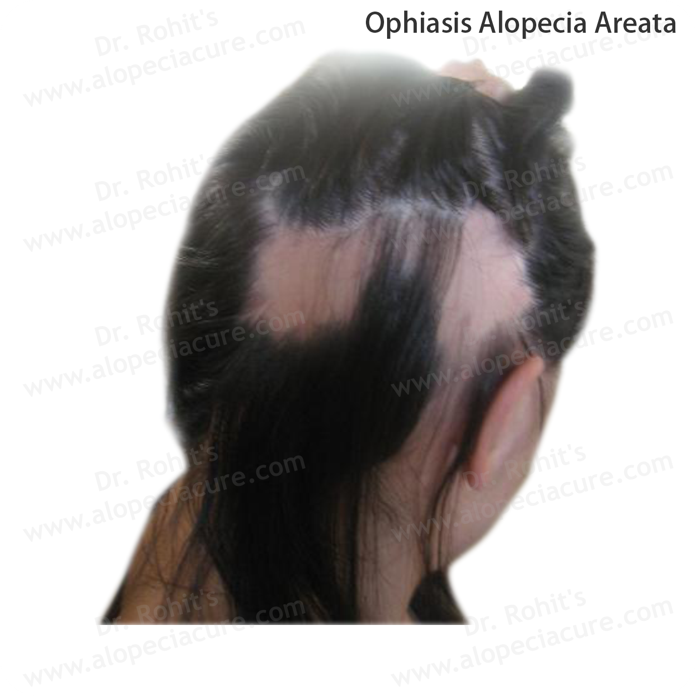 Ophiasis Alopecia Treatment 4