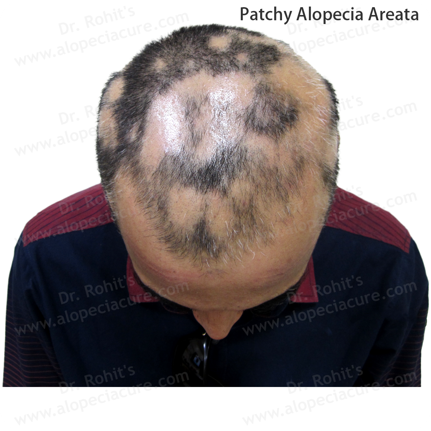 Patchy Alopecia Areata Treatment 1