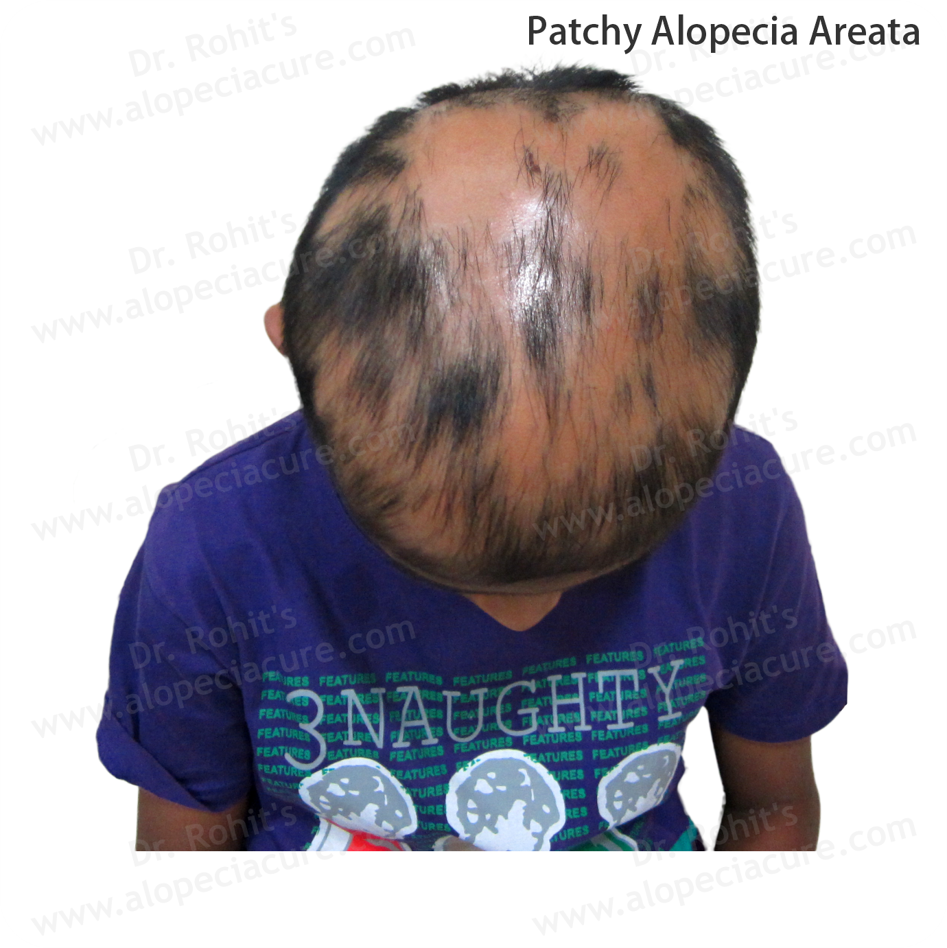 Patchy Alopecia Areata Treatment 2