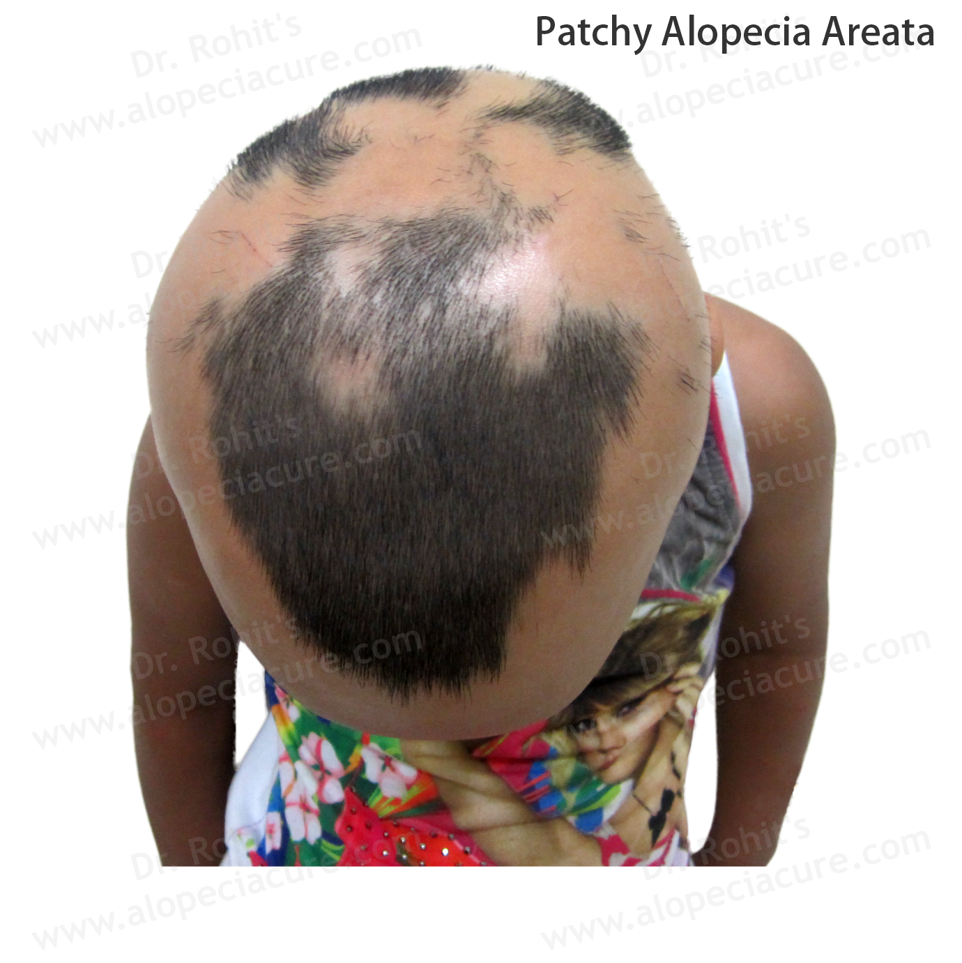 Patchy Alopecia Areata Treatment 3
