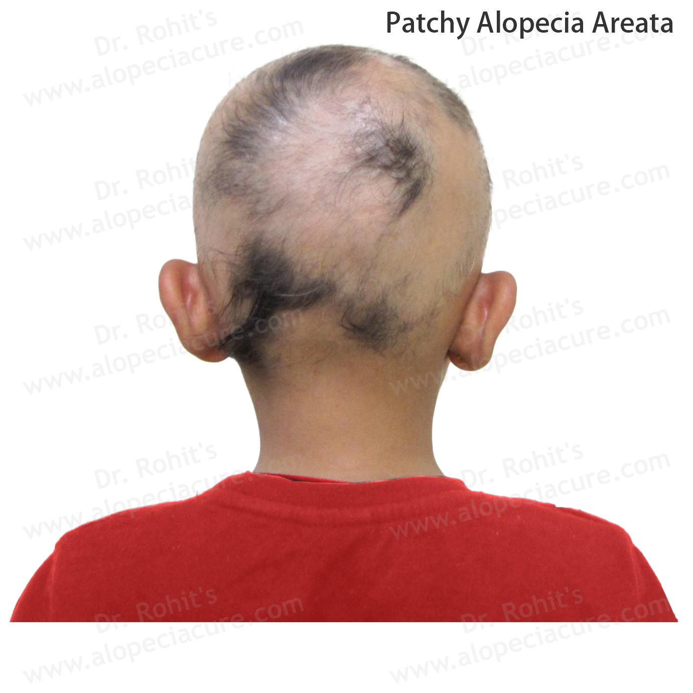 Patchy Alopecia Areata Treatment 4