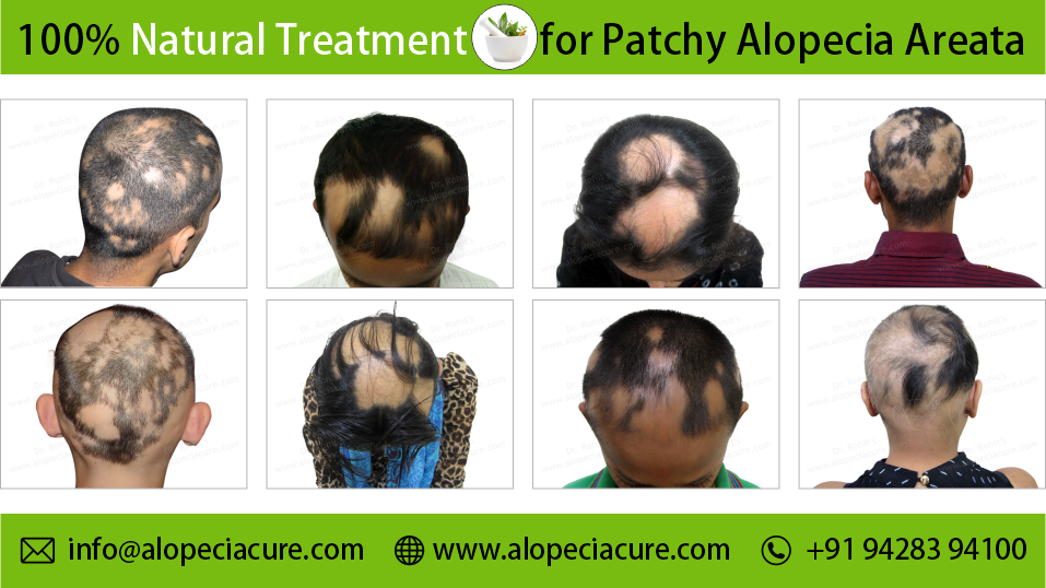 Patchy Alopecia Areata