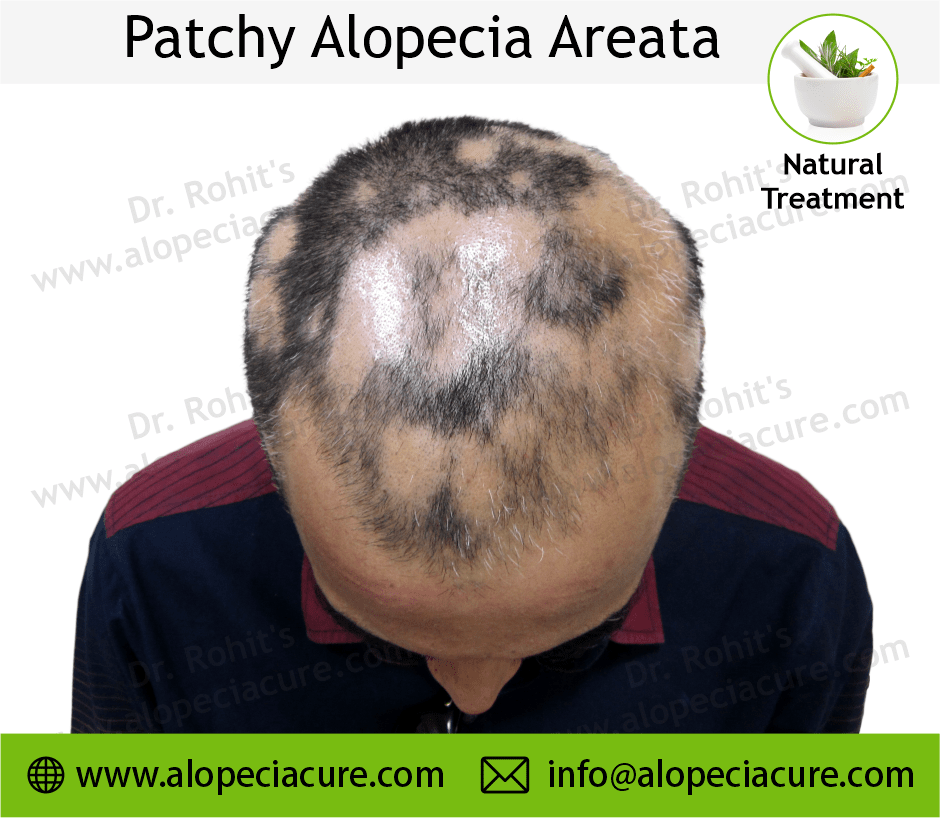 Patchy Alopecia Areata Case 01