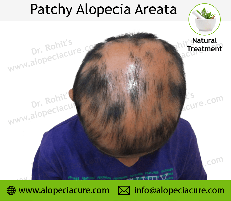Patchy Alopecia Areata Case 02