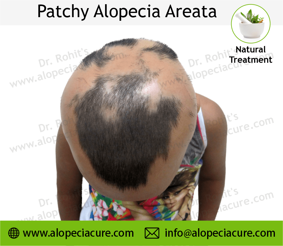 Patchy Alopecia Areata Case 03