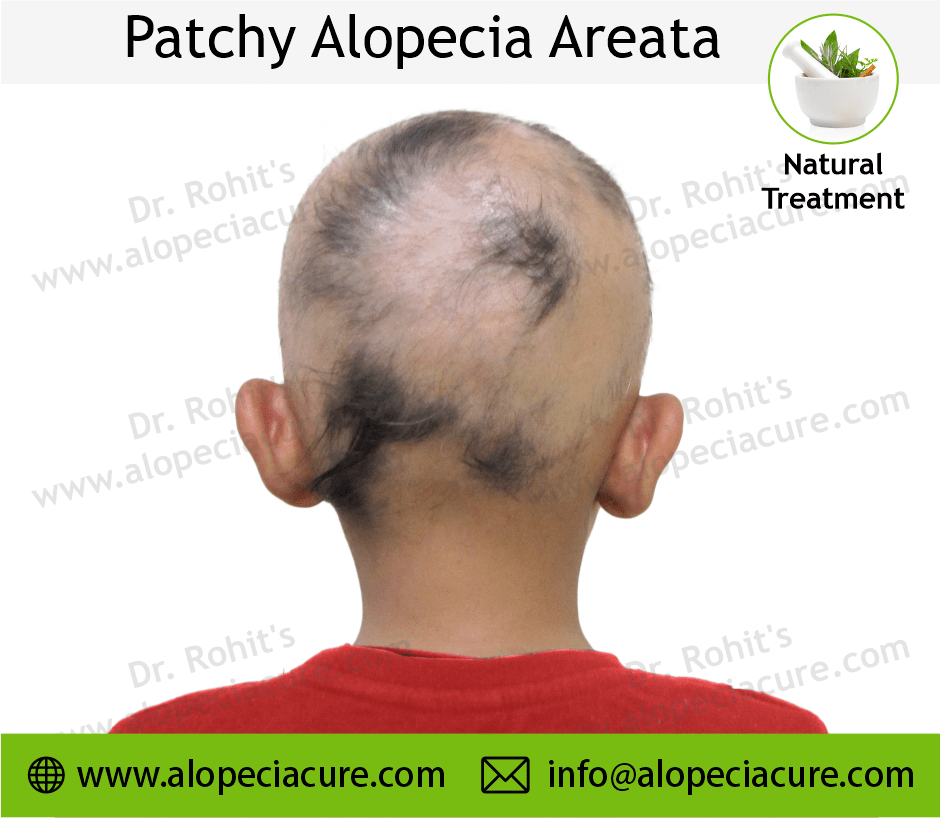 Patchy Alopecia Areata Case 04