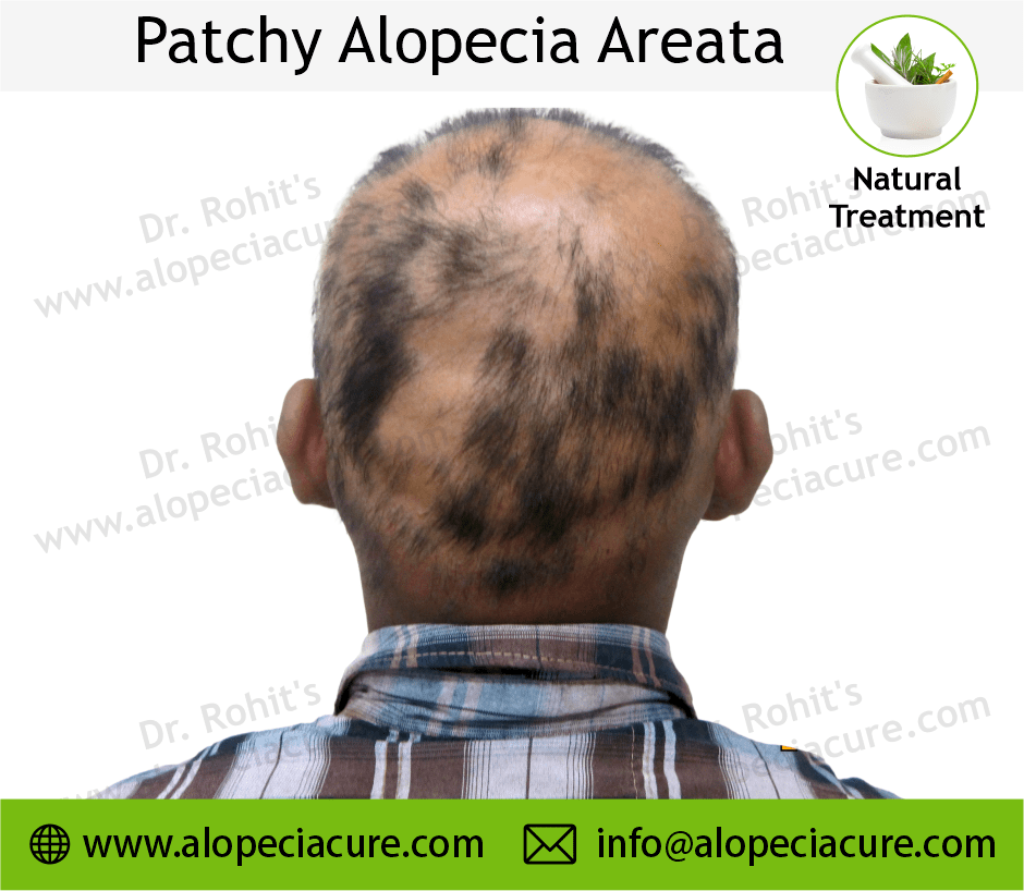 Patchy Alopecia Areata Case 05