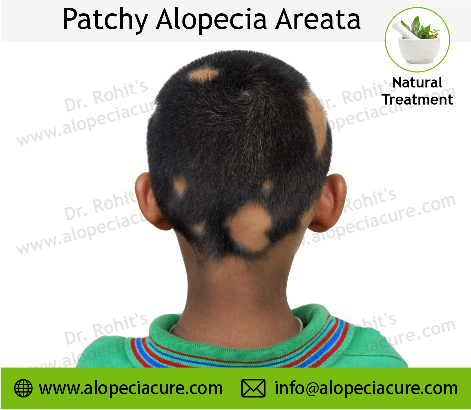 Patchy Alopecia Areata Case 06