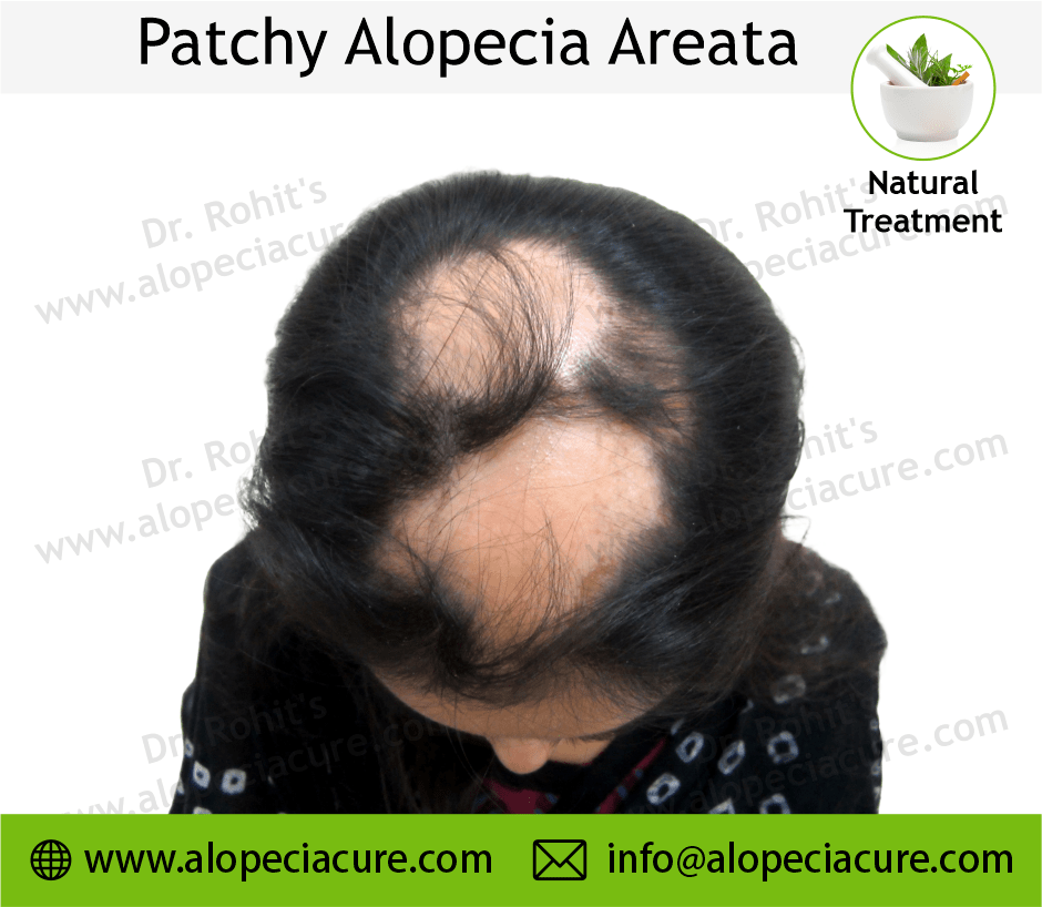 Patchy Alopecia Areata Case 07