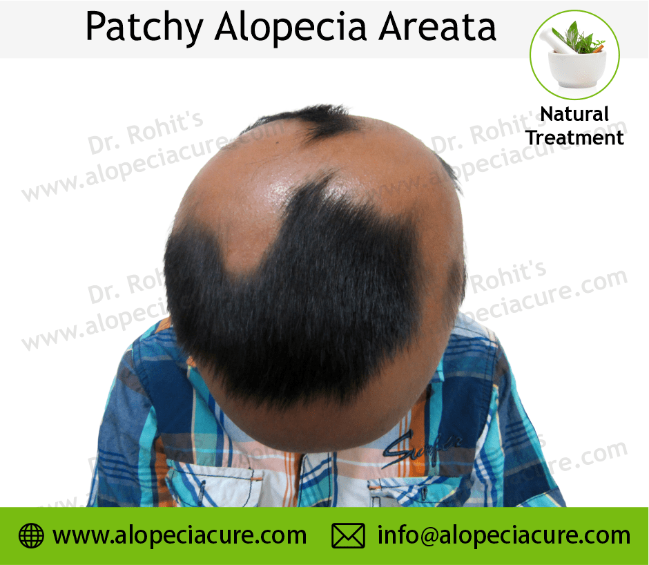 Patchy Alopecia Areata Case 08