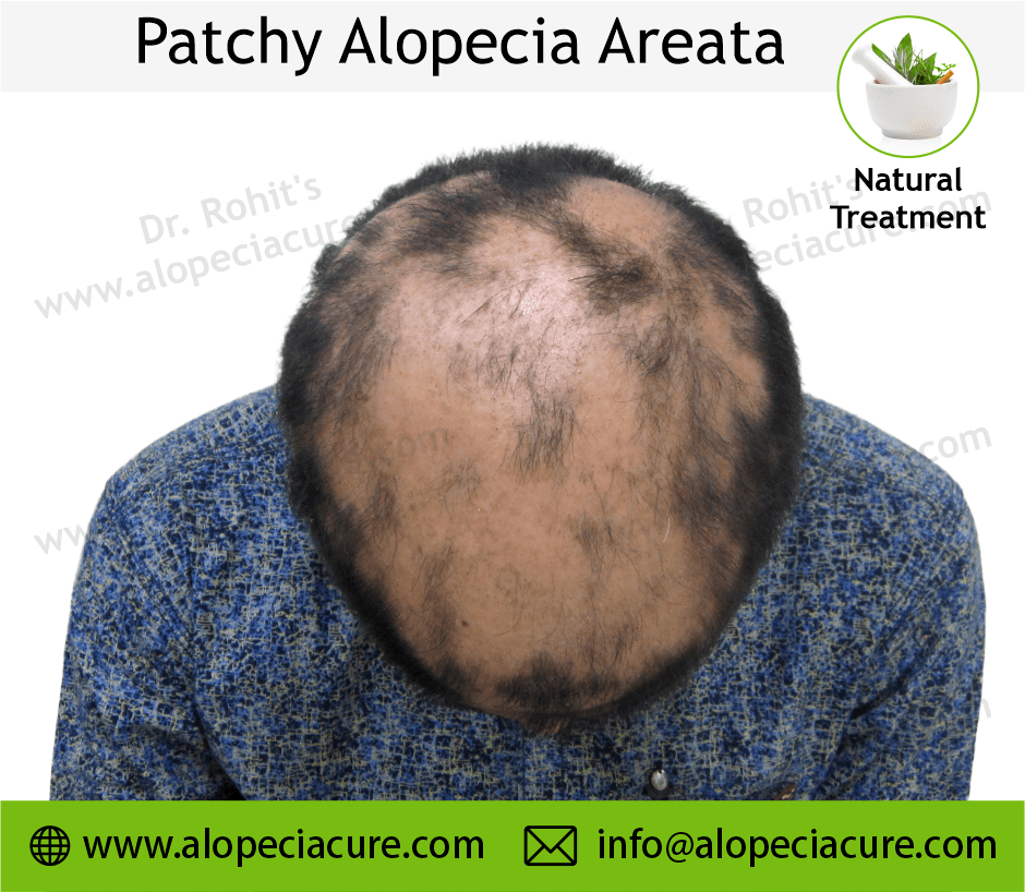 Patchy Alopecia Areata Case 09