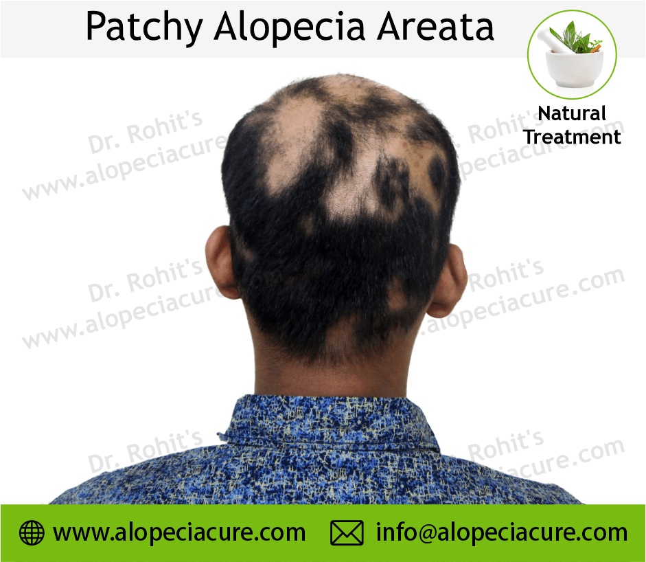 Patchy Alopecia Areata Case 10