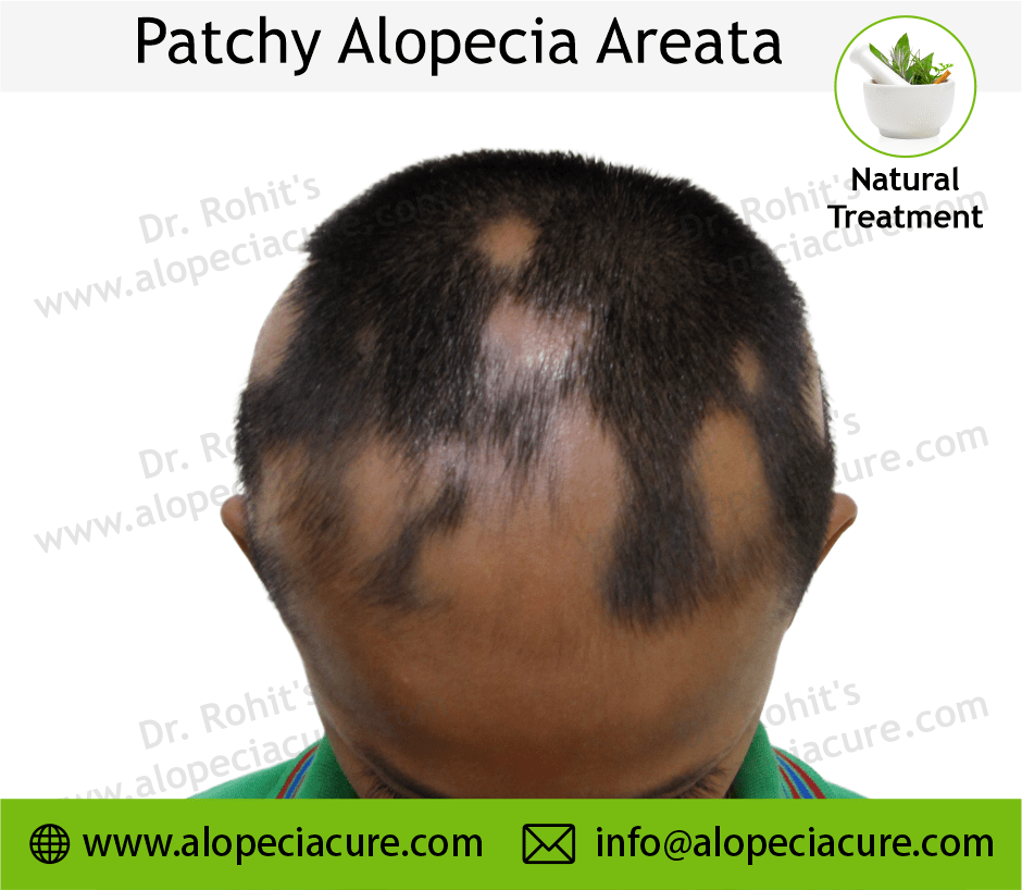 Patchy Alopecia Areata Case 11