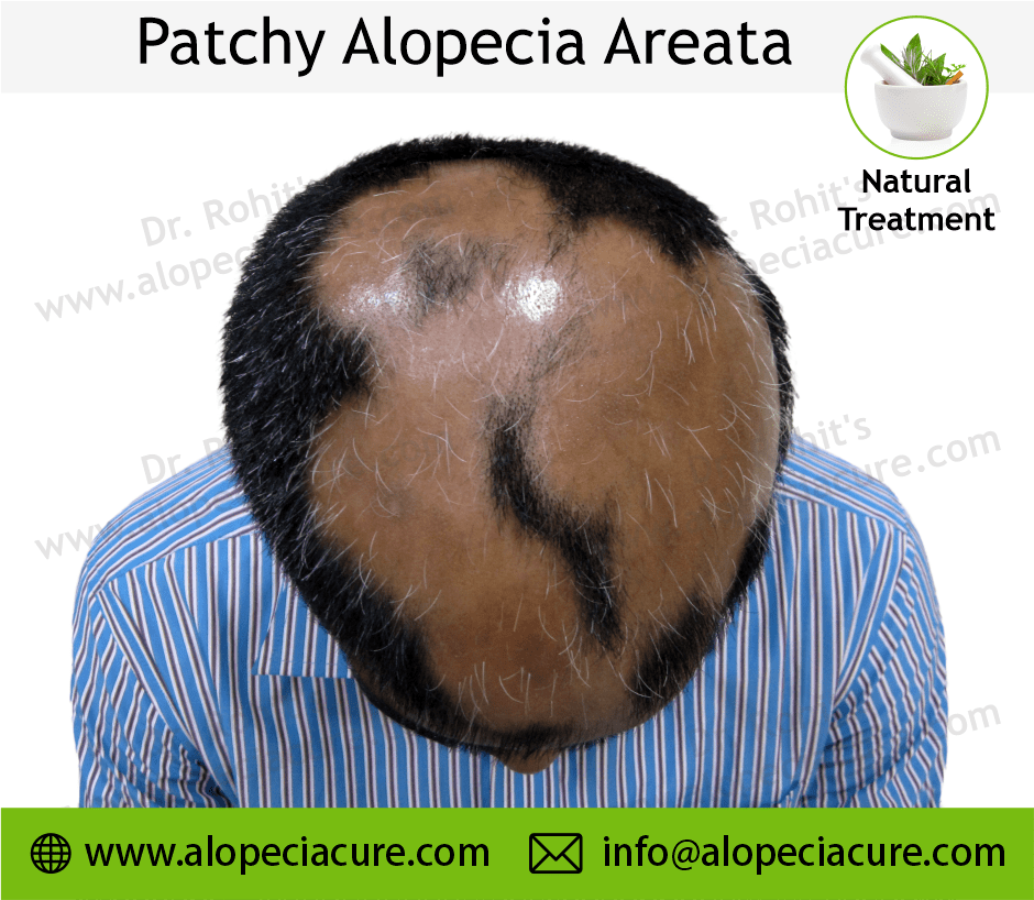Patchy Alopecia Areata Case 12
