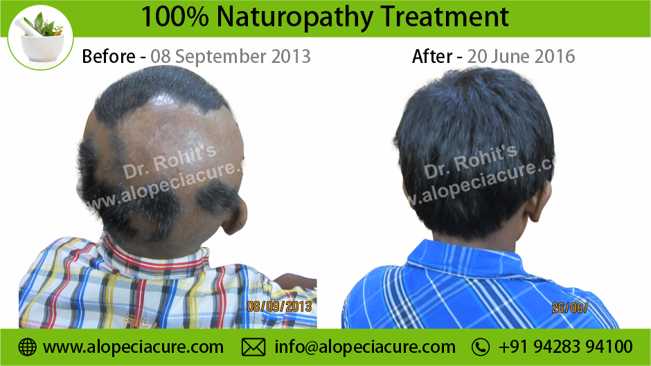 Alopecia Areata Result 03