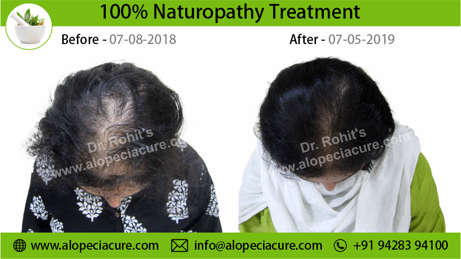 Female Hair Loss Result 06