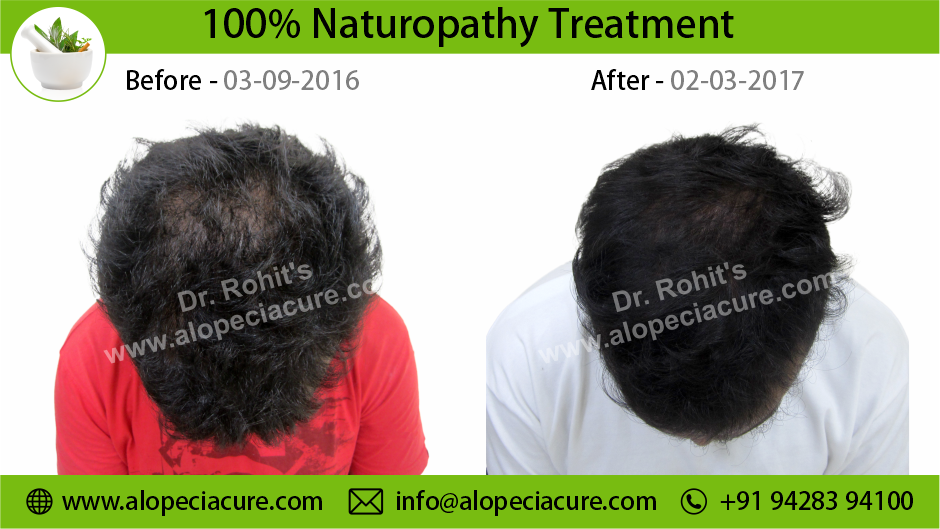 Male Hair Loss Result 07