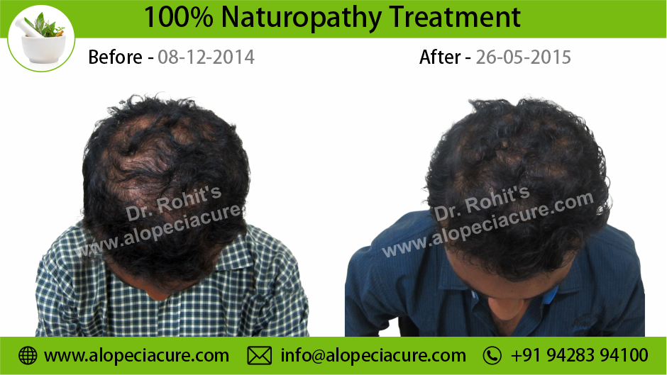 Male Hair Loss Result 08