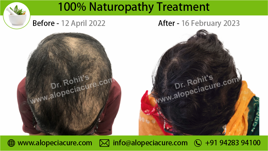 Trichotillomania Result 09