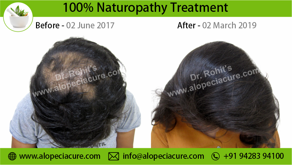 Trichotillomania Result 10