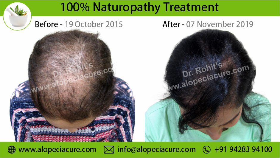Trichotillomania Result 11