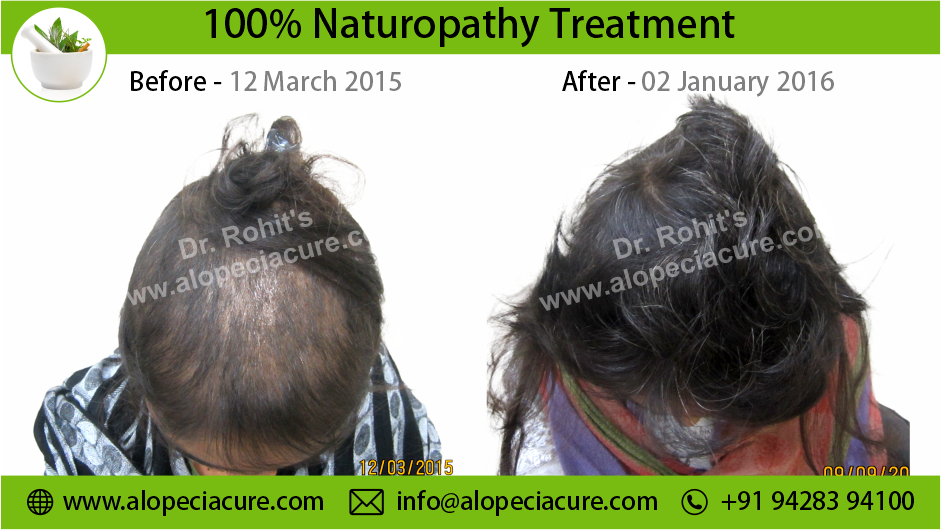 Trichotillomania Result 12