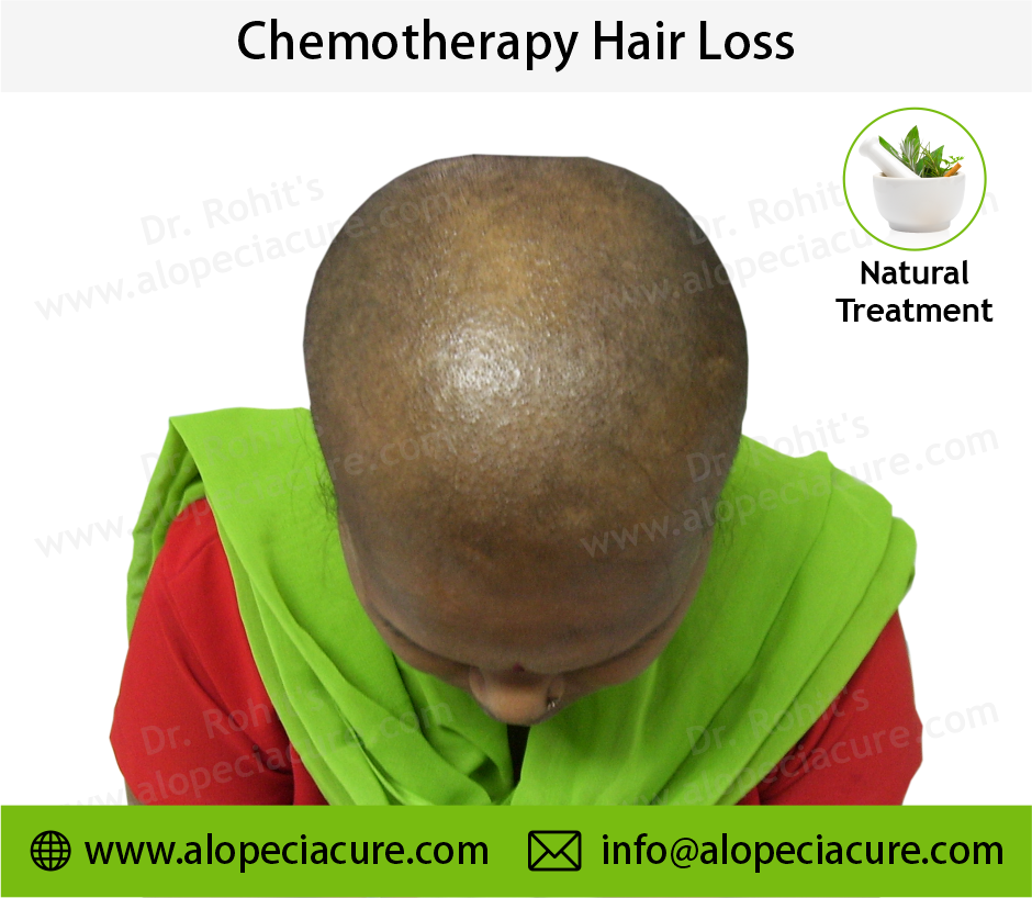 Chemotherapy Hair Loss Result 1
