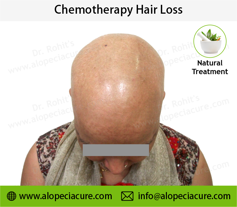 Chemotherapy Hair Loss Result 2